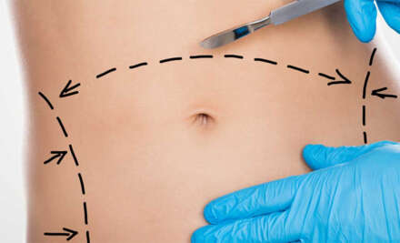 Abdominoplasty